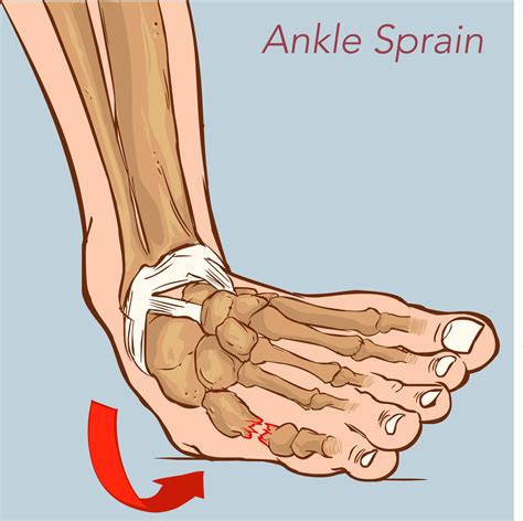 Image result for Inversion Ankle Injury