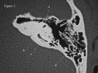 Toradh íomhá ar Temporal Bone CT Scan