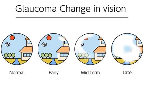 Image result for Visual Field Glaucoma Stages