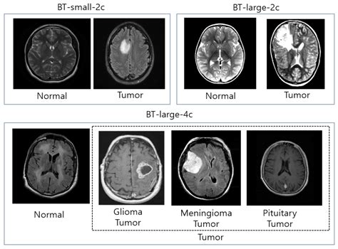 Image result for Deep Learning Classification MRI