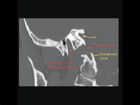 Toradh íomhá ar Temporal Bone CT Scan