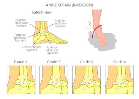 How and Why Does Inversion Ankle Sprain Affect Athletes