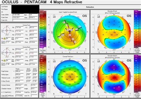 Image result for MATLAB Pentacam