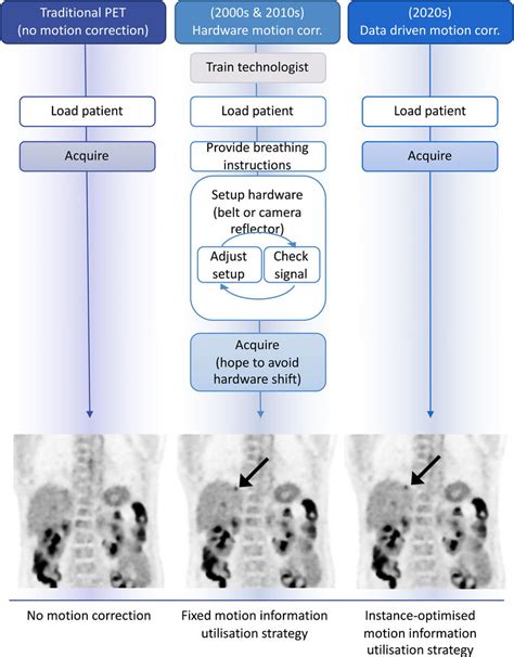 Machine Learning in Pet Scan Workflow に対する画像結果