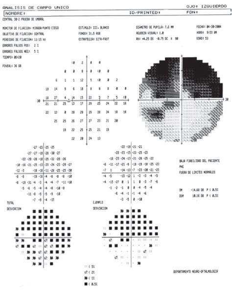 Image result for Altitudinal Visual Field Defect