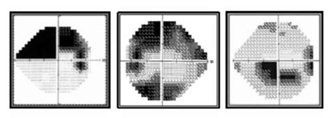 Image result for Visual Field Glaucoma Stages
