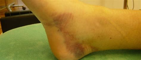 Image result for Inversion Ankle Injury