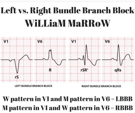 Image result for Left Bundle Branch Block