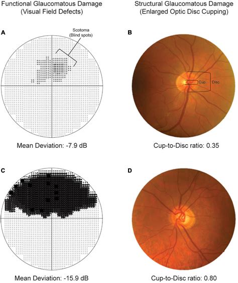 Image result for Glaucoma Eye Damage Visual Field