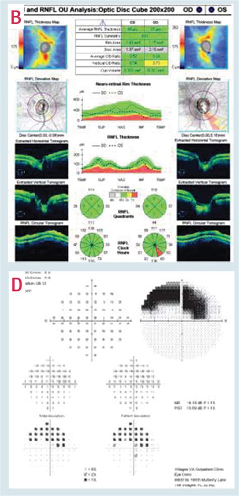 Image result for Advanced Glaucoma Visual Field