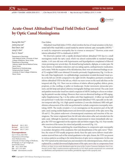 Image result for Altitudinal Visual Field Defect