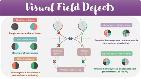 Afbeeldingsresultaten voor Peripheral Visual Field Defect