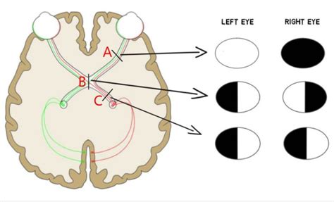 Image result for Visual Field Defects