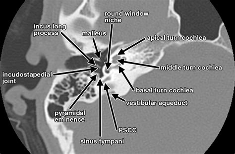 Toradh íomhá ar Temporal Bone CT Scan