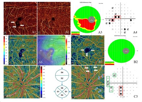 Image result for Keyhole Visual Field Defect