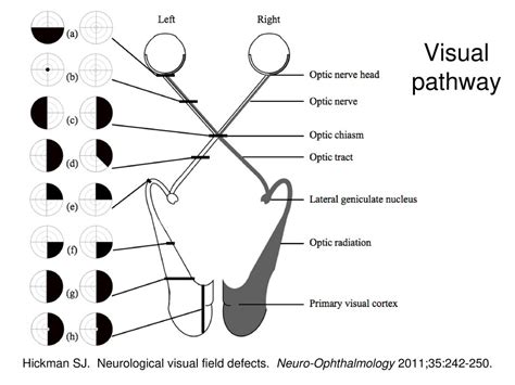 Image result for Visual Field Defect Map