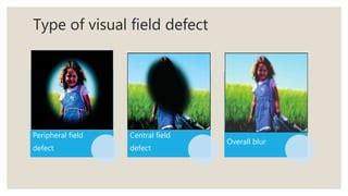 Image result for Peripheral Visual Field Defect