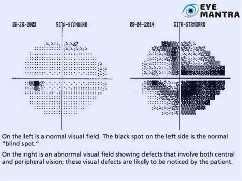 Image result for Advanced Glaucoma Visual Field