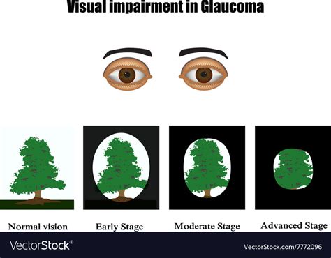 Tunnel Vision Visual Field Glaucoma に対する画像結果