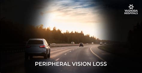 Peripheral Vision Loss Glasses に対する画像結果