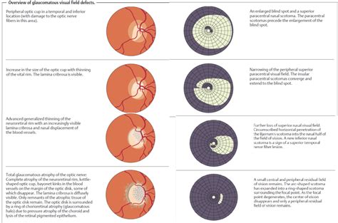 Image result for Glaucoma Eye Damage Visual Field