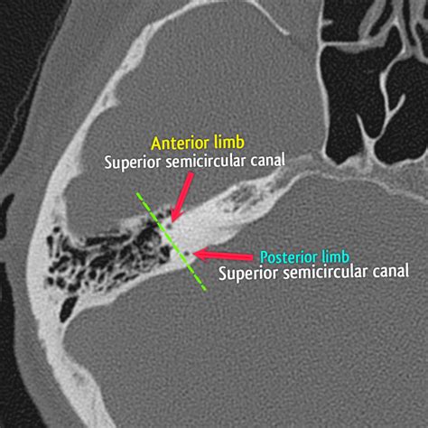 Toradh íomhá ar Temporal Bone CT Scan