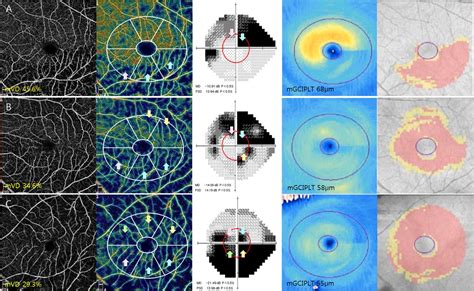 Image result for Macular Split Visual Field Glaucoma