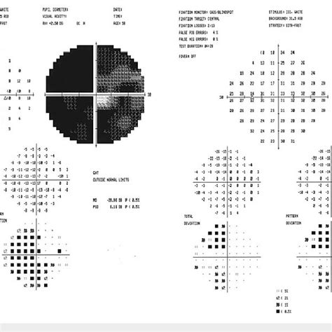 Image result for Visual Field Defect Map