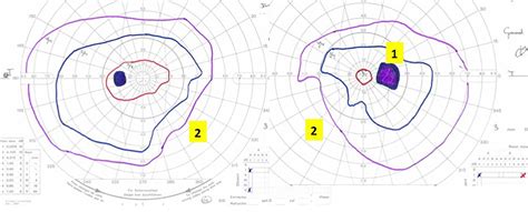 Visual Field Map に対する画像結果
