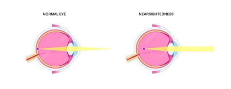 Image result for Normal Vision Near Object Image