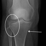 Knee - Tibial Plateau Fracture - AOA Orthopedic Specialists