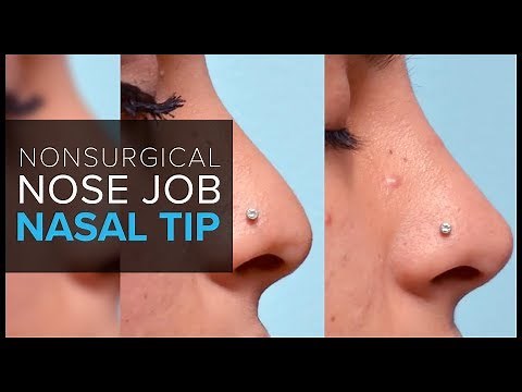 Nonsurgical Nose Job in San Francisco: Fillers for the Nasal Tip