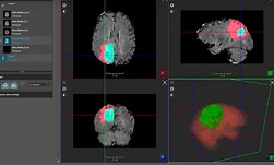Automatically Segmenting Brain Tumors with AI | NVIDIA Technical Blog