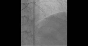 Coronary Angiogram Demonstrating Lad Stent Blockage Stock Footage Video (100% Royalty-free) 3756382295 | Shutterstock