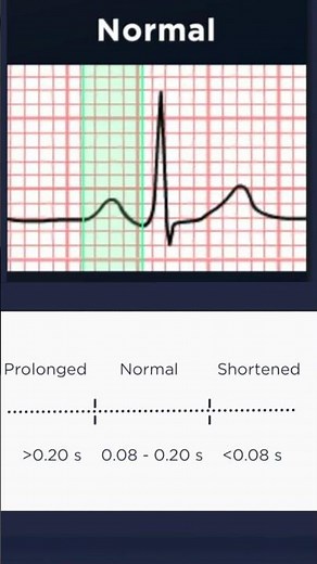 ECG Basics: Normal PR interval duration