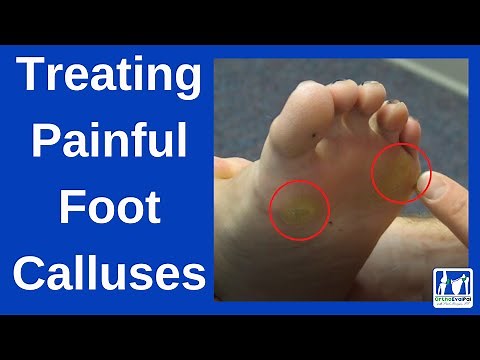 How to Treat Painful Foot Calluses