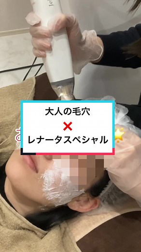 ポテンツァ レナータスペシャル5回の症例です！エクソソームとマックームの薬剤のカクテルです！ #レナータクリニック立川 #肌質改善 #ポテンツァ #ニキビ跡 #毛穴