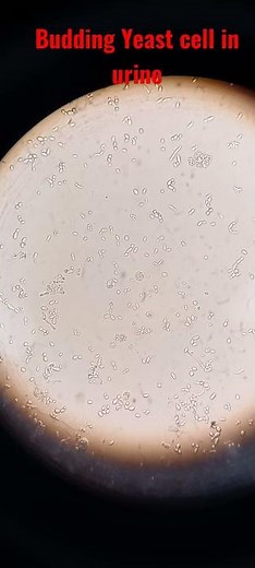 Urine Microscopy |Budding yeast cell and pus cell (WBCs) in Urine |Urine Analysis