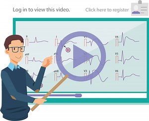 Overview of the ECG Waves, Deflections, Intervals, Durations –