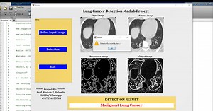 Lung Cancer Detection Using Image Processing Matlab Project With Source Code | Final Year Project