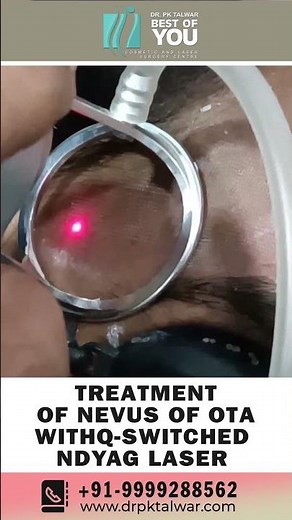 Treatment of Nevus of Ota with Laser | Birthmark Removal Treatment with Laser | Dr. PK Talwar