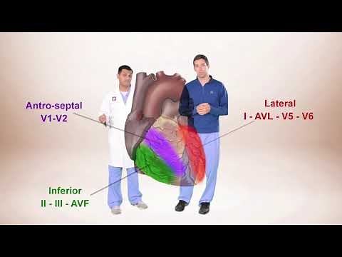 ECG for Beginners. ECG Diagnosis of ST Elevation Myocardial Infarction (STEMI)