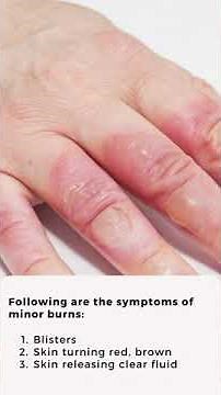 What is the Initial First Aid Treatment for Minor Burns? | Apollo Hospitals