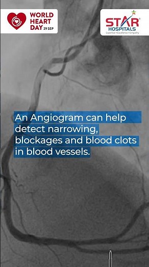 Understand Heart Health | Know About Angiogram
