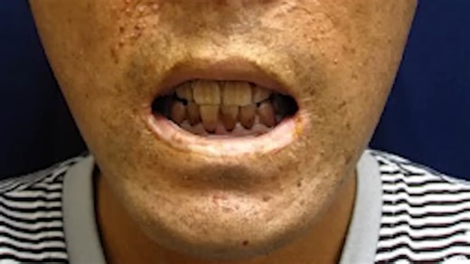 How a Tuberculosis Outbreak Created America’s Vampire Panic