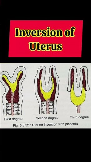 Inversion of uterus.