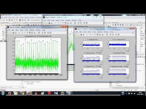 ECG Signal Processing in MATLAB - Detecting R-Peaks: Full
