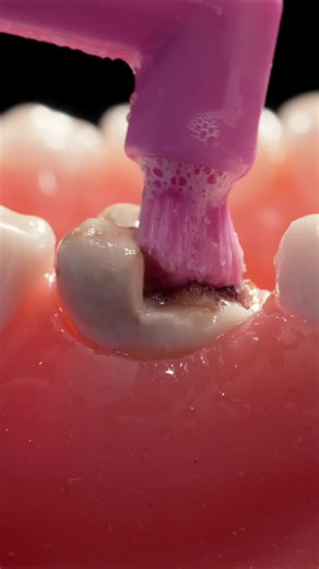 Composite Strip Crown: Transform Your Smile