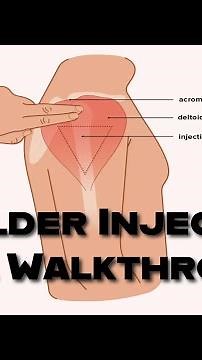 Intramuscular Injections into the Arm (Deltoid): A Step-by-Step Guide