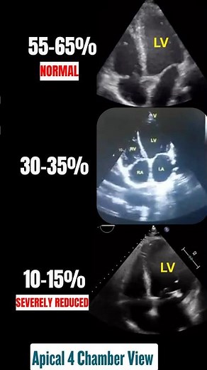 Normal to Severely Reduced Ejection Fraction on Echo | 4 Chambers view #echo